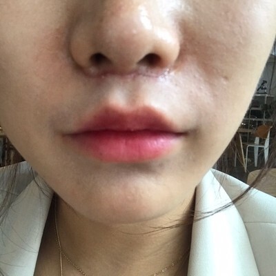 인중 축소 수술 후기