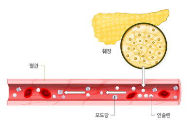 소아당뇨병