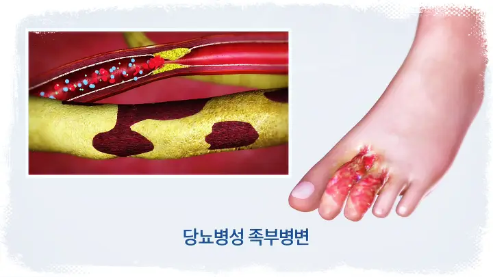 KBS 생로병사의 비밀 813회 늘어가는 당뇨약 혈당조절 실패 및 합병증과 식단 운동