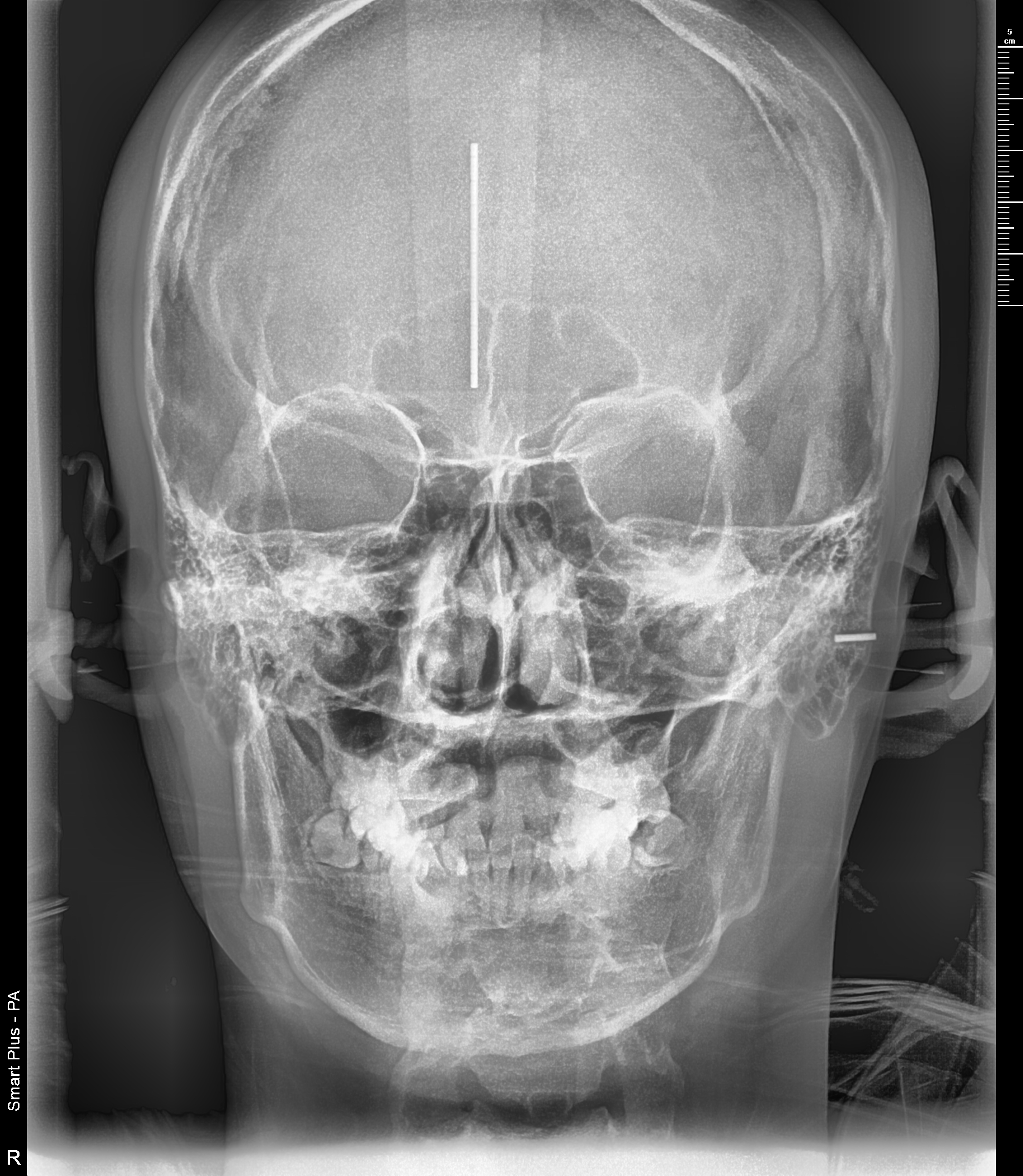 부정교합 가위교합 과개교합 치아교정 후기5