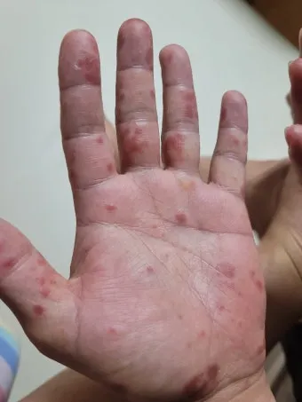 수족구 초기 증상 어른 감염 격리기간 예방 치료 완전 가이드_16