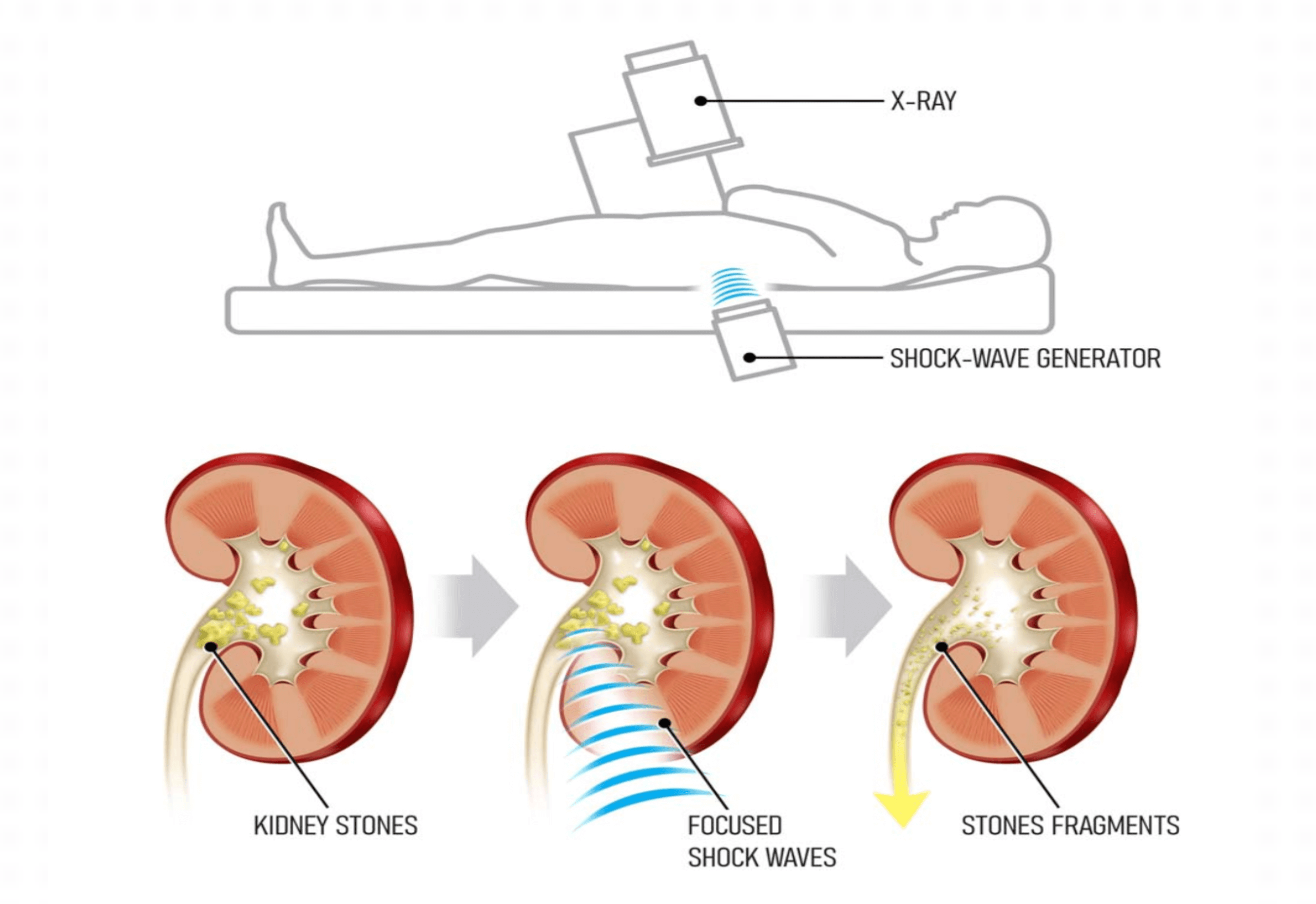 요로결석 체외 충격파