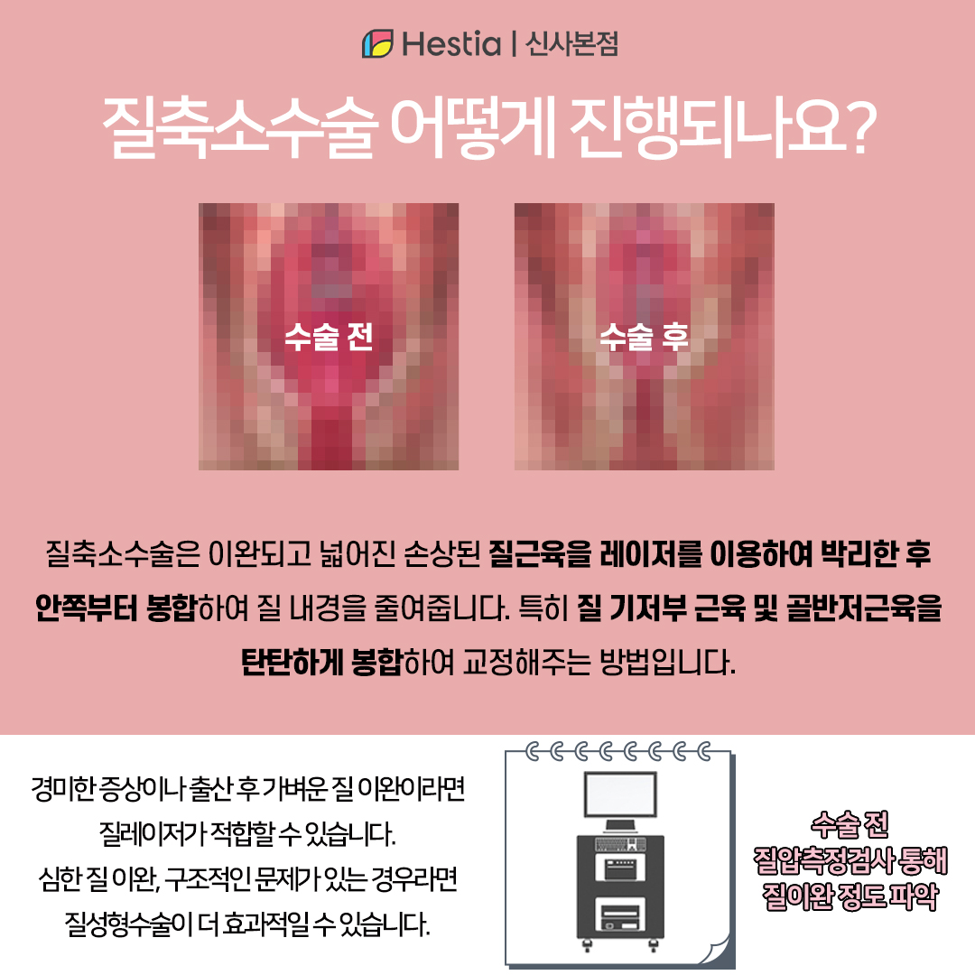 질축소수술이란?