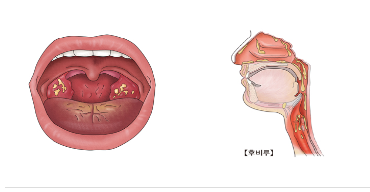 편도결석 빼는법 원인 제거 가글 방법 완화하기!