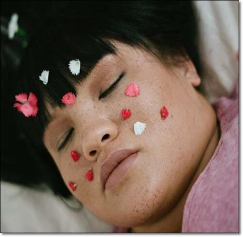 심상성어린선 증상