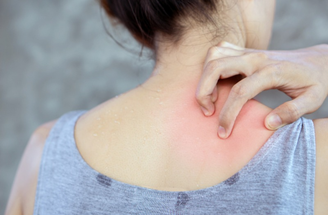 등에 붉은 부분을 긁고 있다.