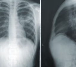 만성폐쇄성 폐질환 진단법 치료 합병증 관리