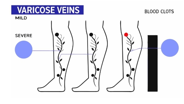 하지정맥류 원인과 의심증상