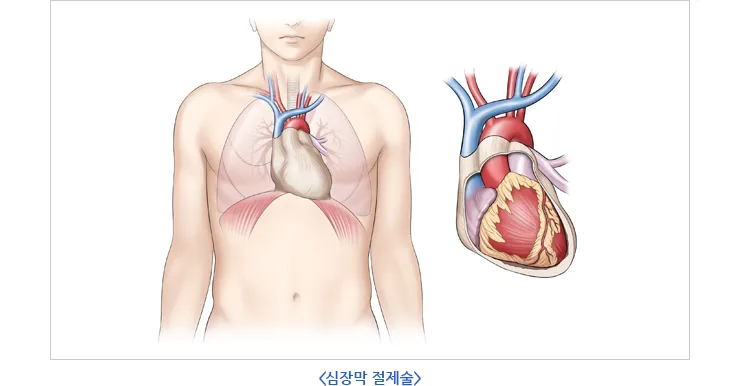 심장에 물이 차는 이유와 관련 질병_5