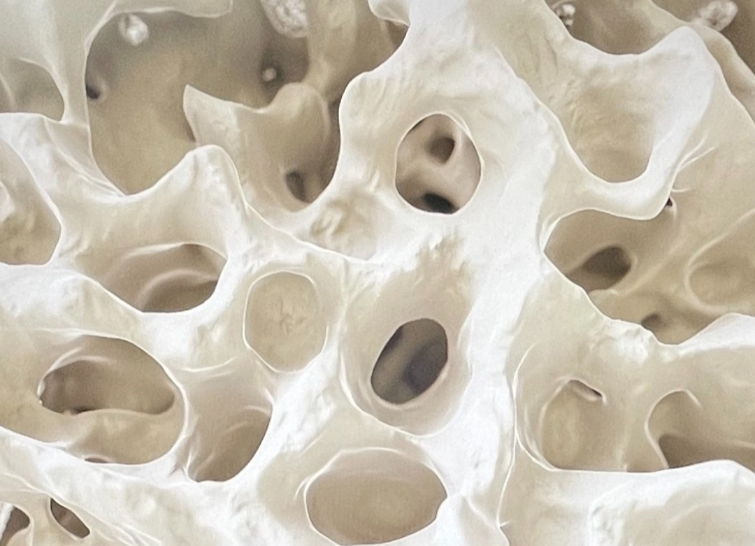 골다공증이 있는 뼈사진