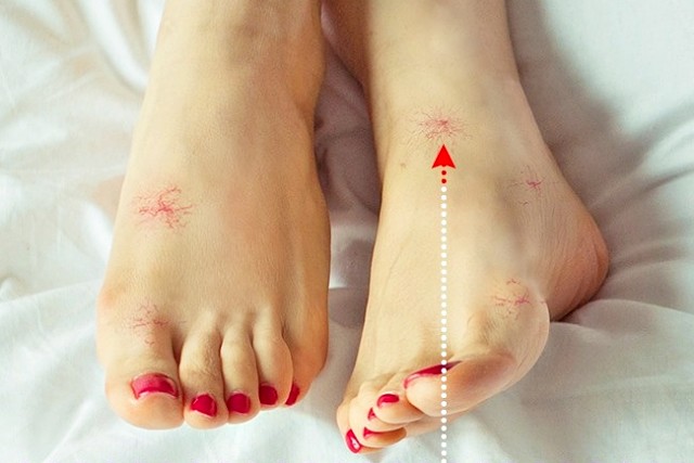 거미혈관종 정맥류 증상