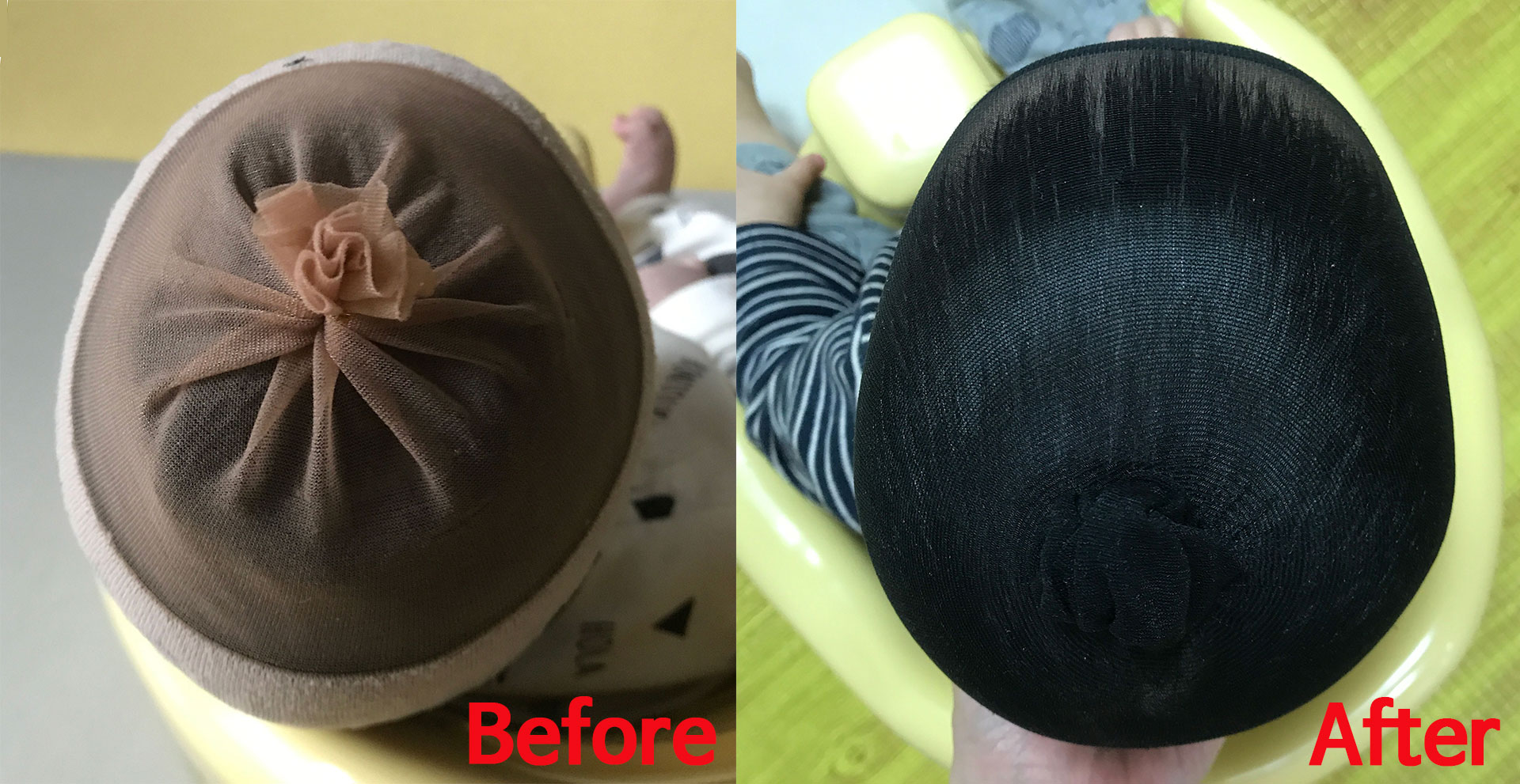 신생아 사두증 - 교정 전과 교정 후 비교