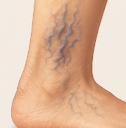 하지 정맥류 증상