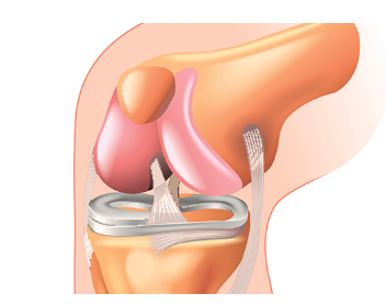 무릎 통증, 50대 이상 64%가 겪는 이유는?