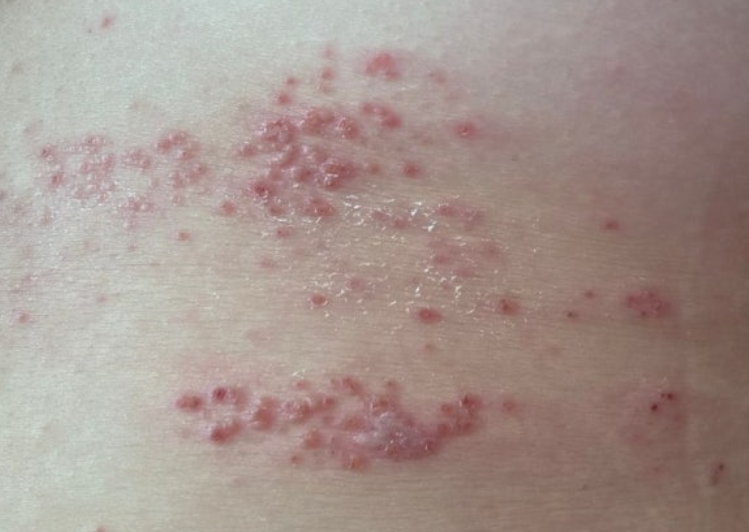 대상포진-초기증상-피부