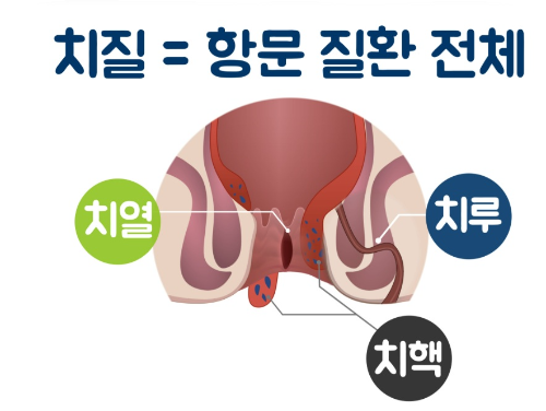 치질(치핵+치루+치열)에 대해서 자세히 알아보자
