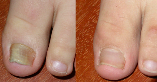 발톱무좀 없애는 방법 5