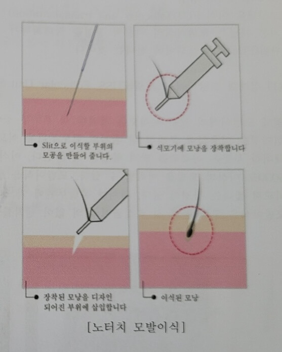 노터치 모발이식 이미지