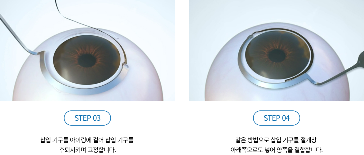 아이링수술, 아이링수술후기, 써클렌즈 대체, 눈동자확대수술, 미용성형, 안과 시술, 렌즈부작용