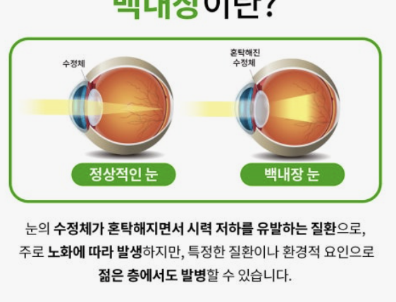 백내장 원인과 치료방법