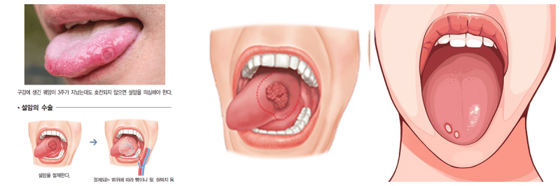 설암, 설암 초기 사진