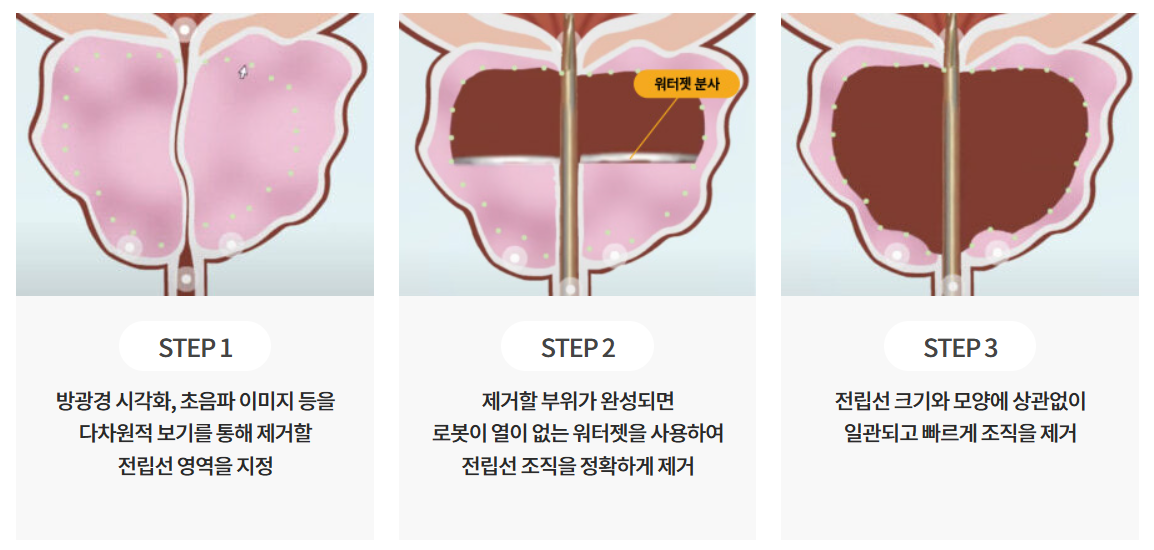 워터젯수술