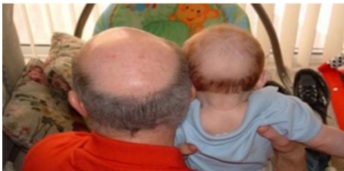 유전적인 탈모 이미지