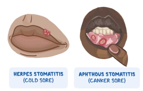단순포진성구내염-아프타성구내염