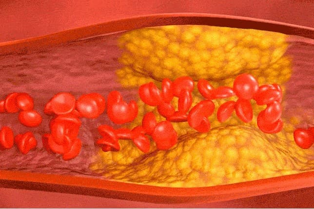 솔티스 혈관 클리어