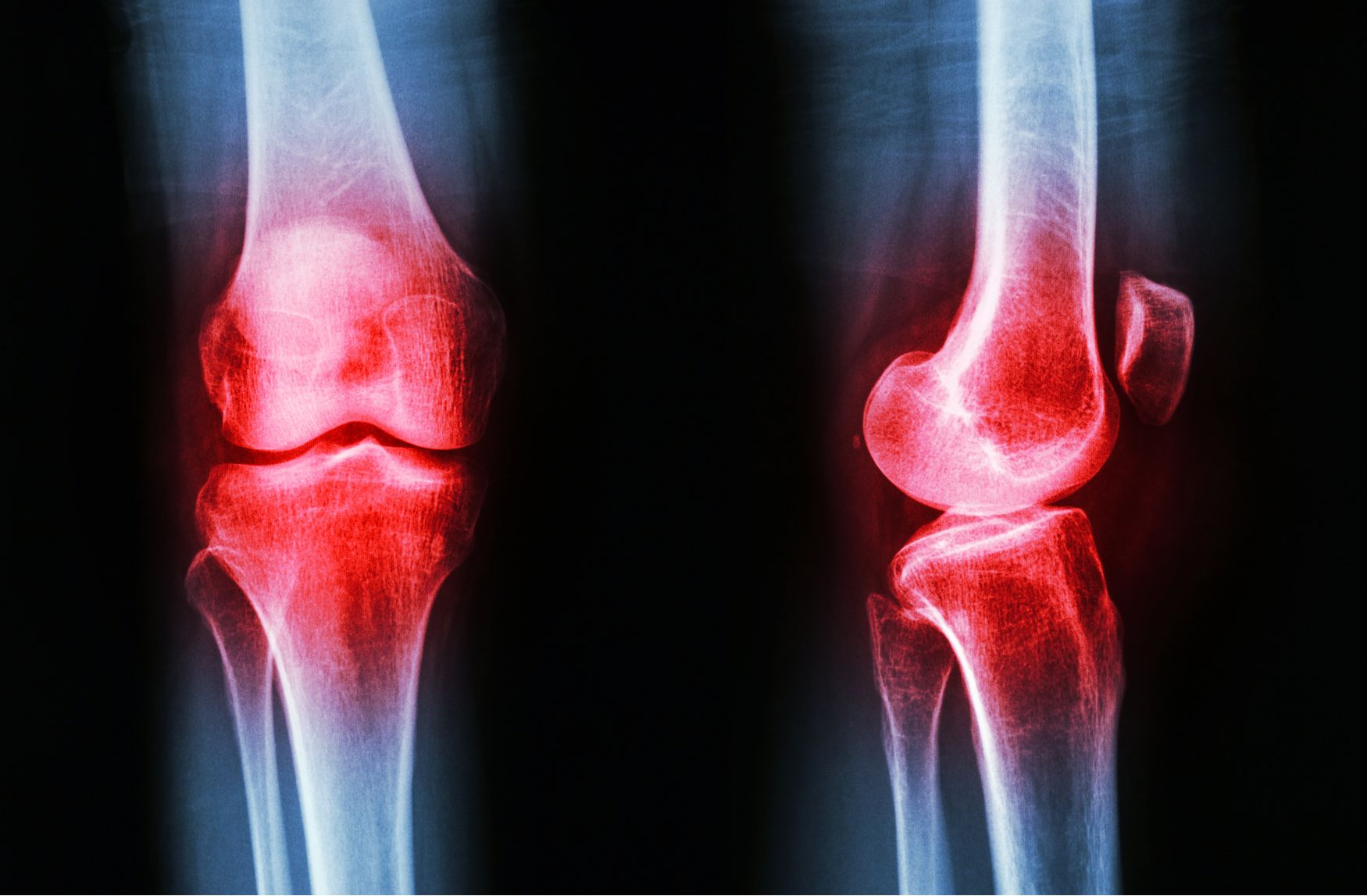 무릎 염증 치료법