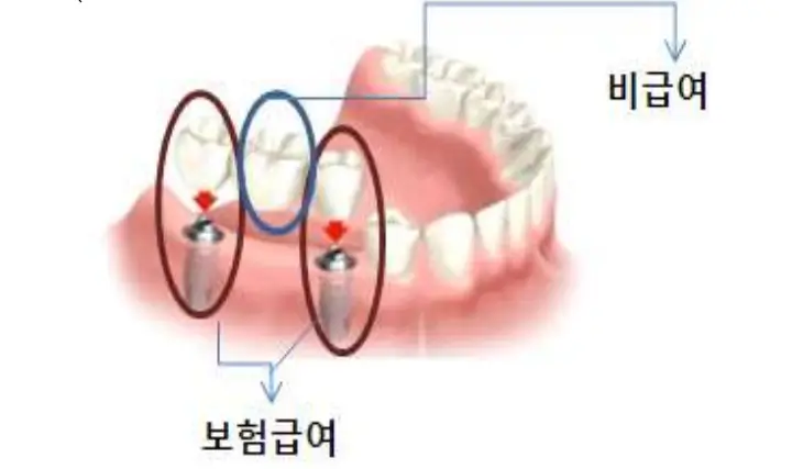 국민건강보험-임플란트-보험