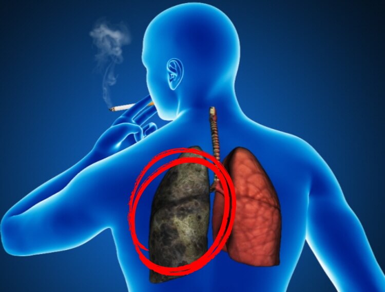 폐암의-원인-흡연