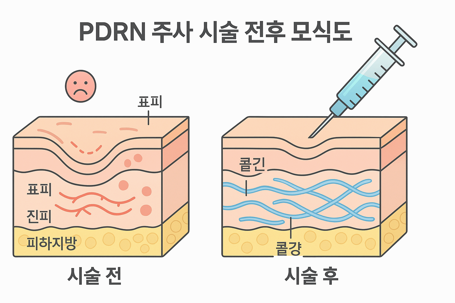 PDRN 크림 vs 주사 vs PN 차이/PDRN 크림 허가로 달라진 판도