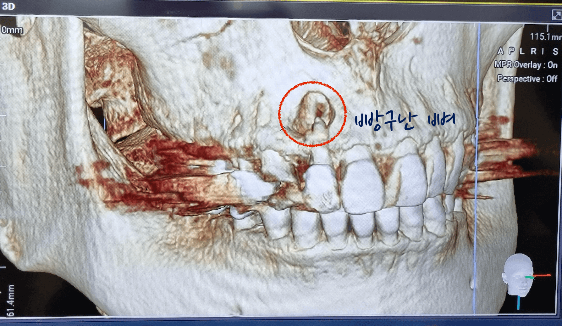 염증 뼈손실