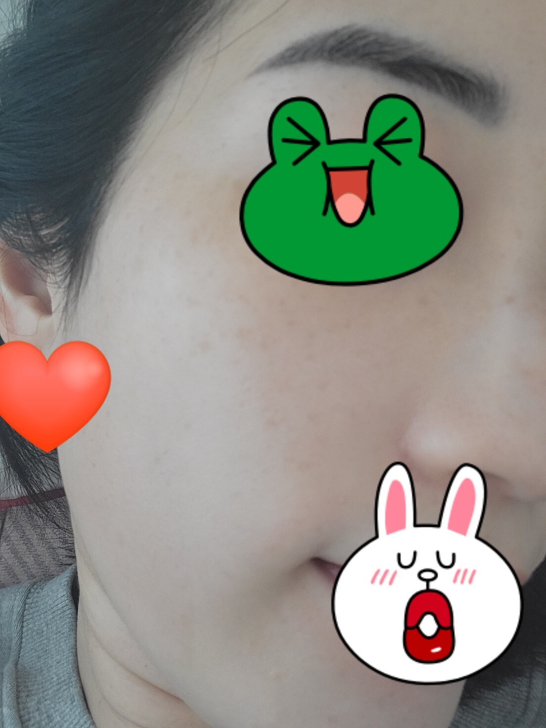 흑자레이저 후기