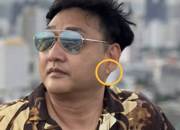 김수용 프랭크징후