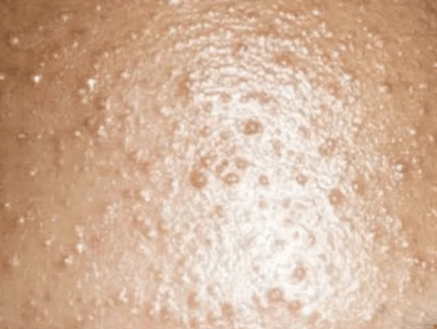 말라쎄지아(진균성 모낭염) 