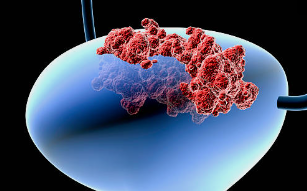 요실금 치료 수술 방법 요실금 수술 후 회복기간 / 요실금 건강보험 적용 시 수술 비용