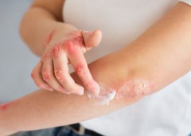 콜린성-두드러기-4