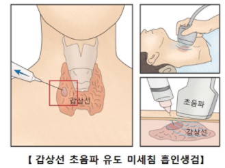 갑상선-검사