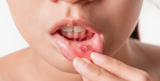 구내염 사진