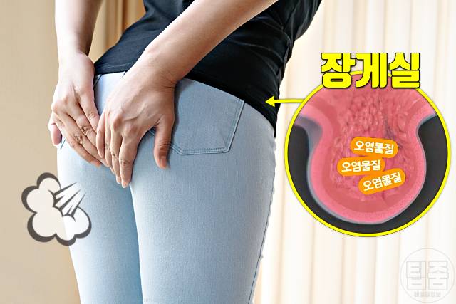 장 안좋을때 증상 방귀 장 안좋으면 여드름 주사비