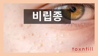 비립종 생기는 이유 비립종 없애는 방법 피부 관리법_13