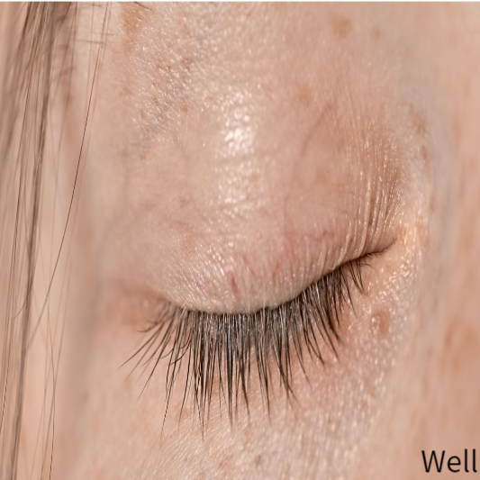 기미 없애는 방법