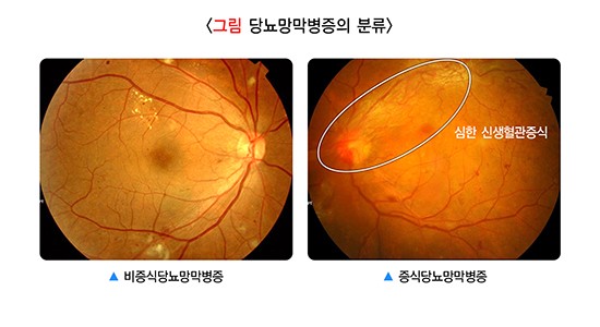 당뇨망막병증