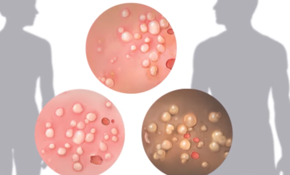 헤르페스 2형 증상