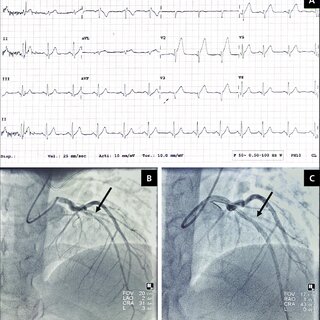 EKG 및 관상동맥 조영술로 진단한다.
