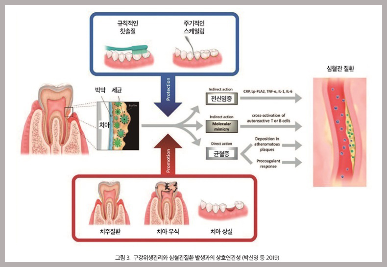 치주질환 -잇몸병이 당뇨·조산 부른다