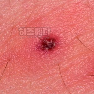 쯔쯔가무시 증상