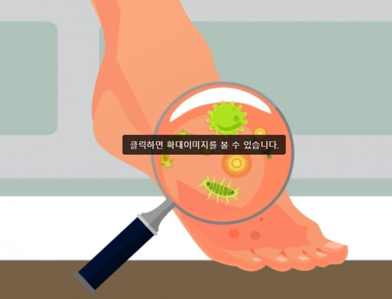 무좀 치료 시 꼭 지켜야 할 주의사항